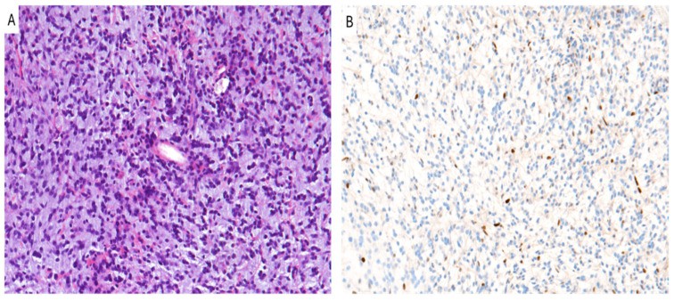 Diffuse midline glioma, H3 K27-altered.