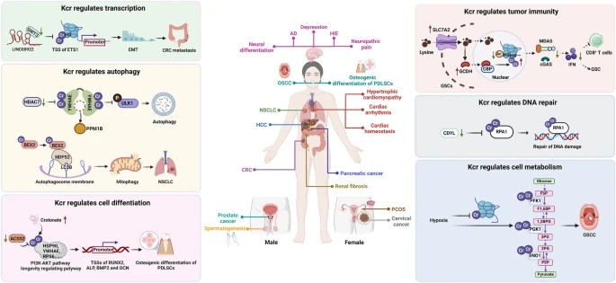 Biological functions of protein Kcr in diseases.