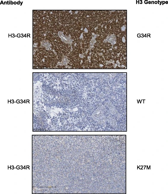 H3-G34R antibody immunostaining correlates with histone H3.3 genotyping.