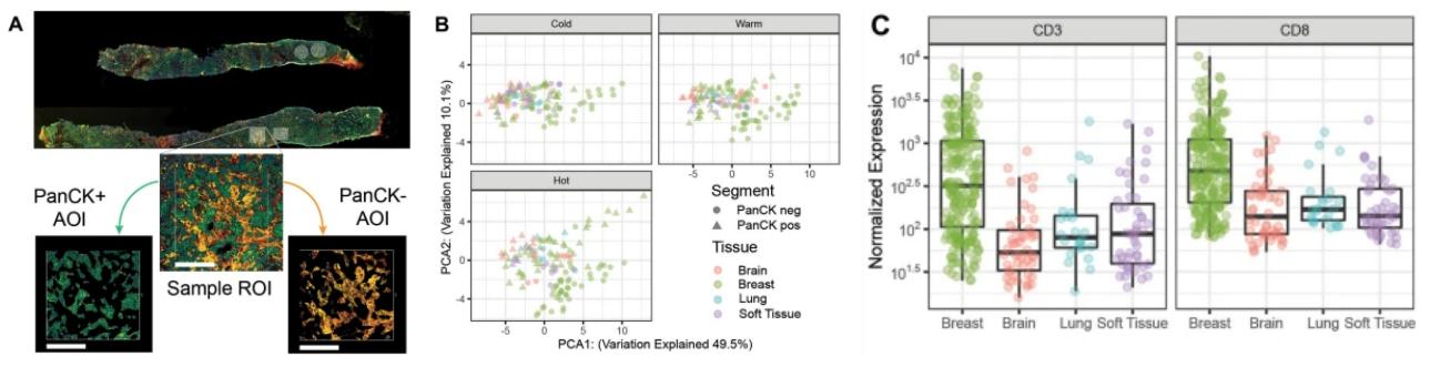 DSP protein expression analysis of primary VS metastases