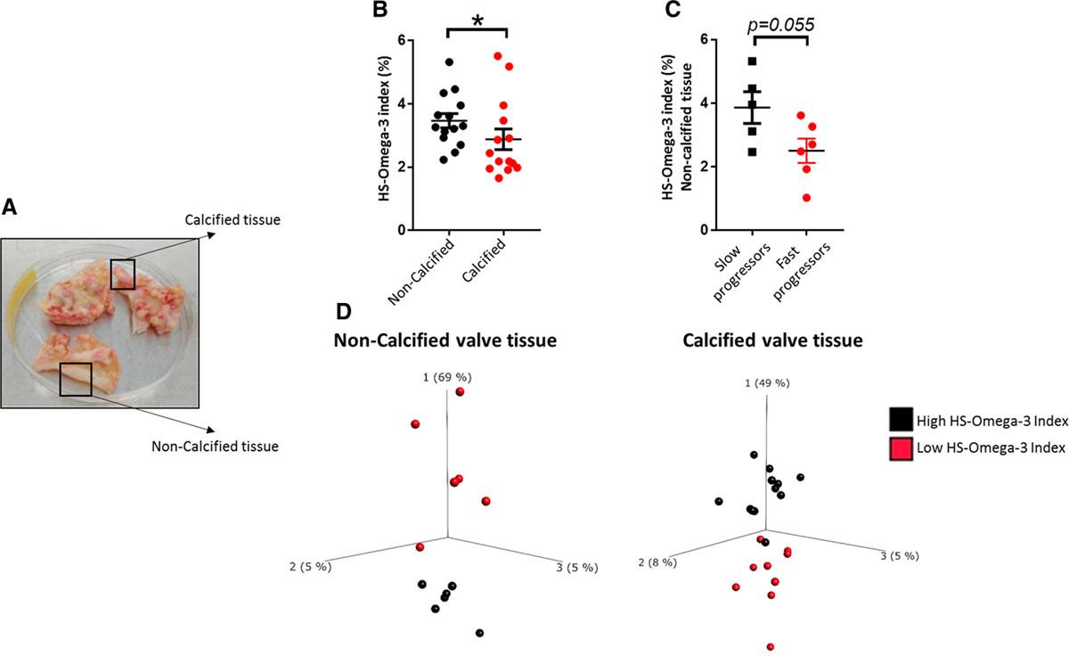 HS-omega-3 index is decreased in calcified aortic valve tissue and is lower in noncalcified valve tissue of aortic valve stenosis (AVS) fast progressors.